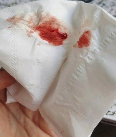 白条带血的原因解析